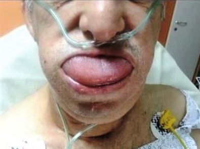 חולה עם אנגיואדמה (צילום: ד"ר אבנר רשף)