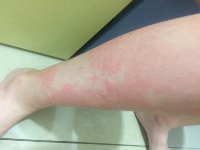 אורטיקריה (צילום: ד"ר אבנר רשף)