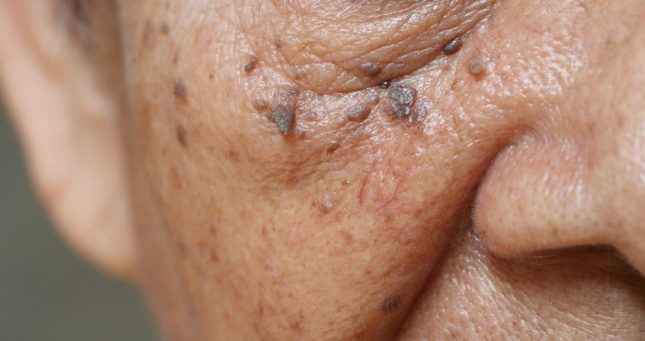 בינה מלאכותית תוכל לזהות אם המלנומה חוזרת - medpage