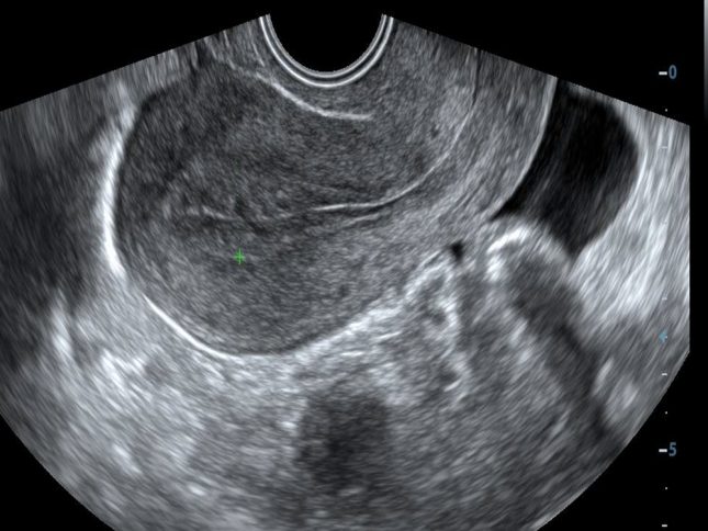 אולטרסאונד-של-רחם.-אילוסטרציה