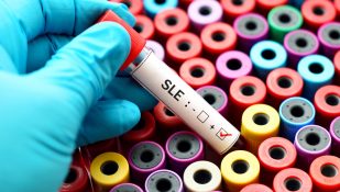 לופוס, זאבת. אילוסטרציה