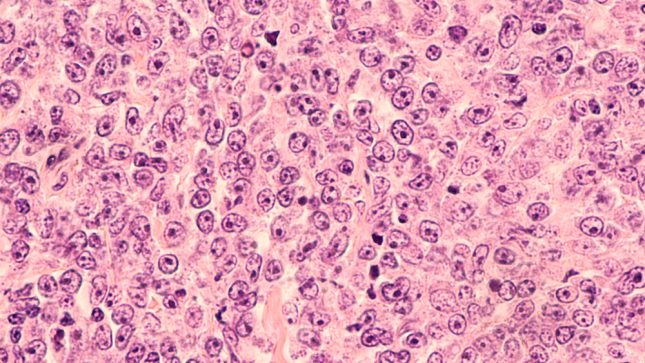 לימפומה-של-תאי-B. אילוסטרציה