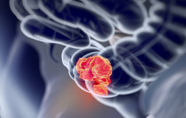 סרטן-המעי-הגס. אילוסטרציה