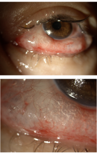 כך נראתה עינה של המטופלת. נפיחות עצומה וחוסר יכולת להניע את העין. צילום: דוברות "מאיר"