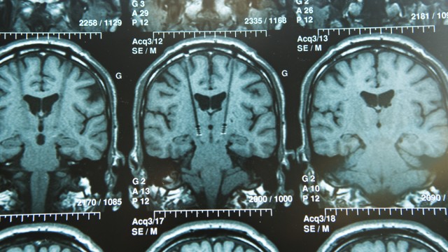 גירוי מוחי עמוק. צילום: אילוסטרציה