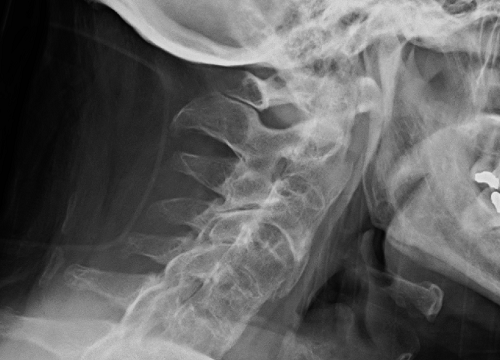 דלקת חוליות מקשחת (מתוך:ויקיפדיה)