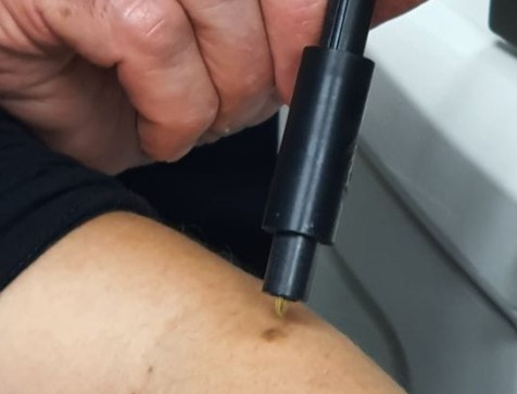 סיבים אופטיים מאפשרים לזהות את אופיו של הנגע העורי. צילום: דוברות אונ' ת"א