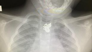 תליון חד הקרן כפי שנראה בצילום רנטגן. צילום: דוברות "קפלן"