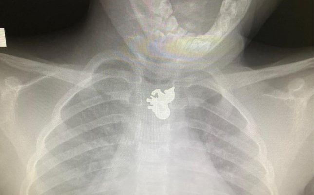 תליון חד הקרן כפי שנראה בצילום רנטגן. צילום: דוברות "קפלן"