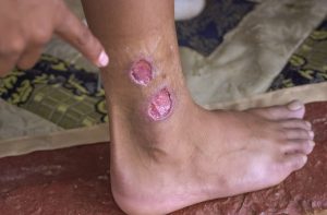 כיבים עוריים במחלת שושנת יריחו. אילוסטרציה