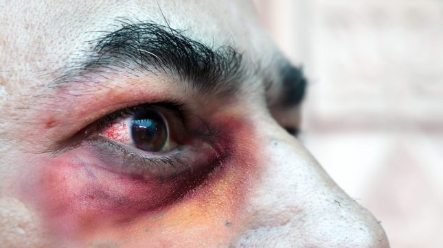 זיהום בפטריה השחורה Mucorales. אילוסטרציה