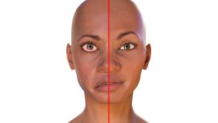 שיתוק פנים ע"ש בל. אילוסטרציה