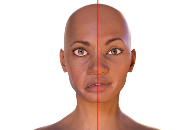 שיתוק פנים ע"ש בל. אילוסטרציה