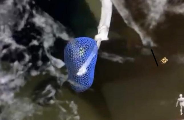 נגע בריאות בתלת מימד. צילום: דוברות בית החולים הכרמל