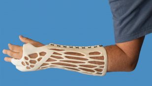 קיבוע פולימרי שמודפס בתלת מימד. צילום: איכילוב