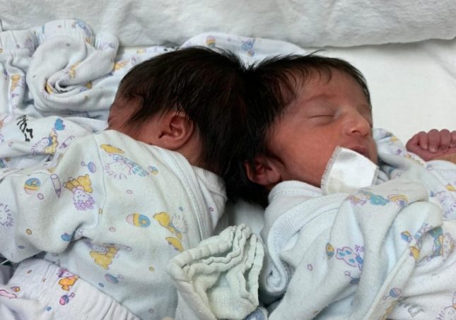 התאומות טרם הניתוח. צילום: בית החולים סורוקה