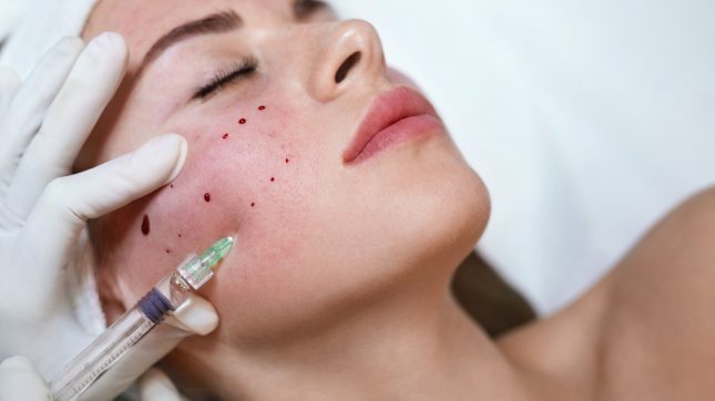 מילוי קמטים. אילוסטרציה