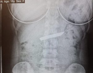 צילום רנטגן, בו ניתן לראות את להב הסכין בבטן העליונה של הנערה. צילום: המרכז הרפואי לגליל נהריה