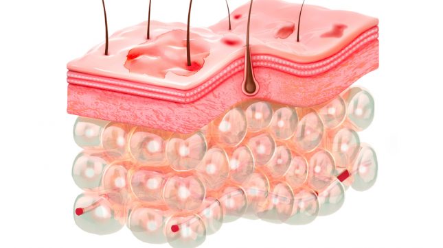 אטופיק דרמטיטיס. אילוסטרציה