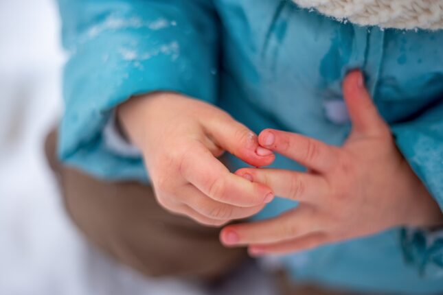 ילד סובל מקור, כוויות קור, היפותרמיה. אילוסטרציה