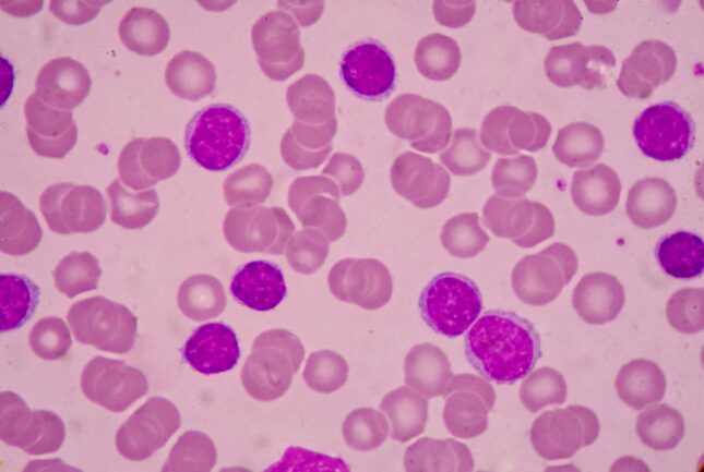 לוקמיה מיאלואידית כרונית. אילוסטרציה
