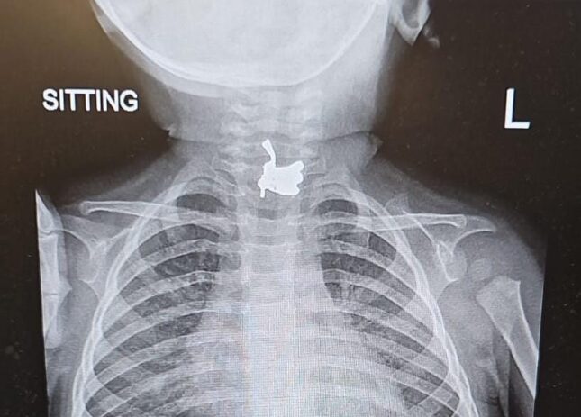 בליעת חפץ זר. צילום: דוברות מאיר