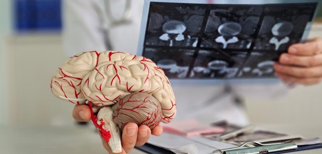 שבץ מוחי. אילוסטרציה