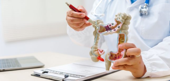 סרטן המעי הגס. אילוסטרציה