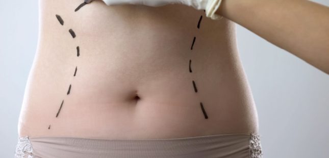 מתיחת בטן. אילוסטרציה