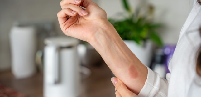 כוויה. אילוסטרציה